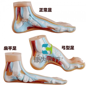 “康為醫(yī)療”正常足、扁平足、弓型足模型